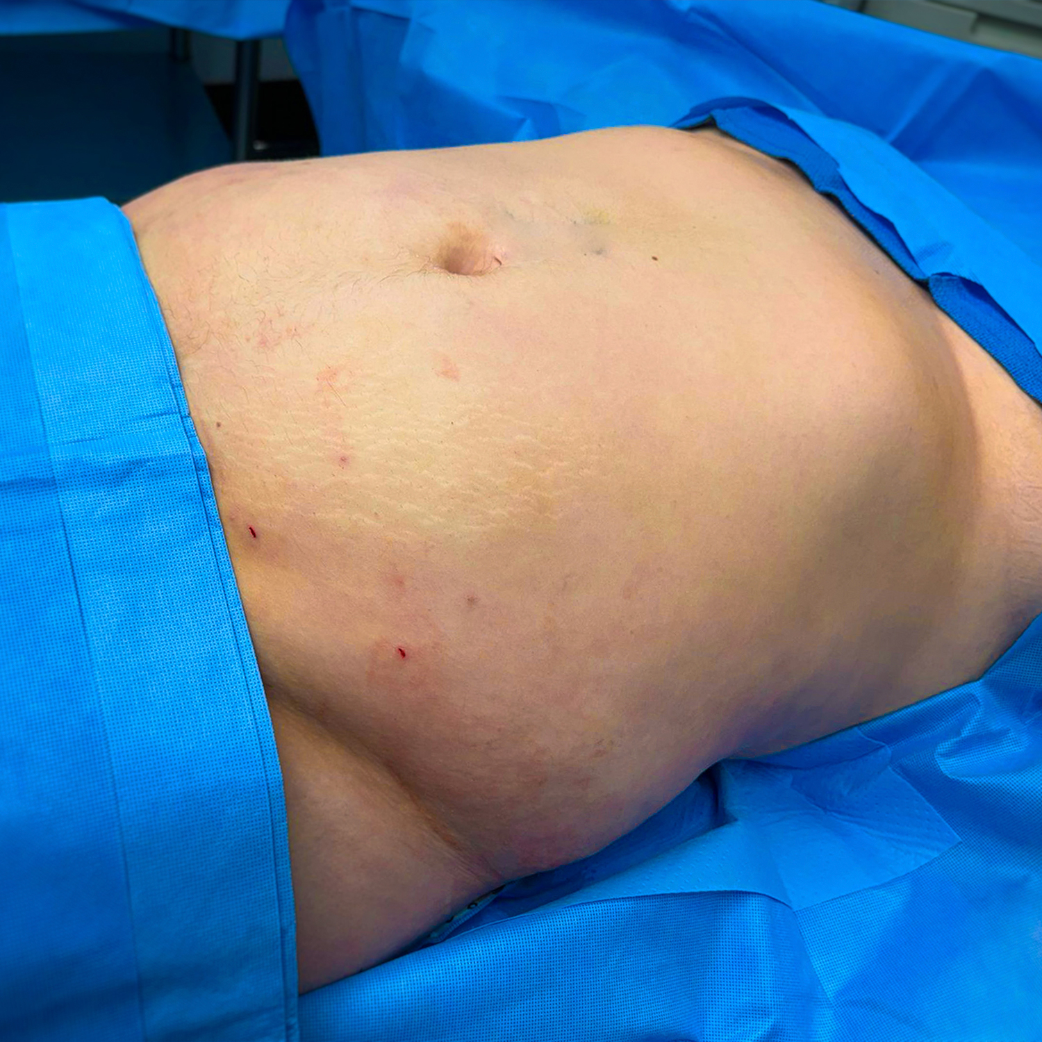 2-morales-lipo-before