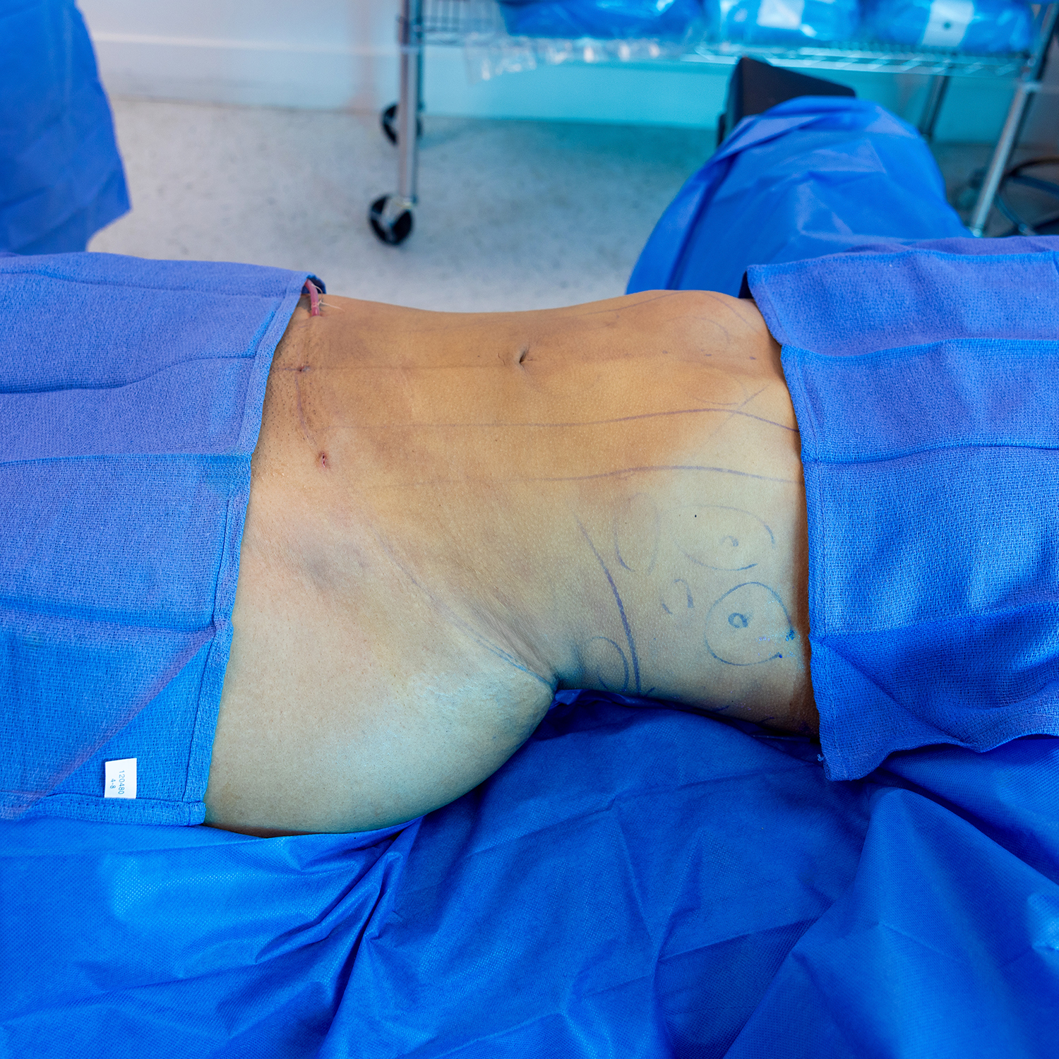 3-morales-lipo-after