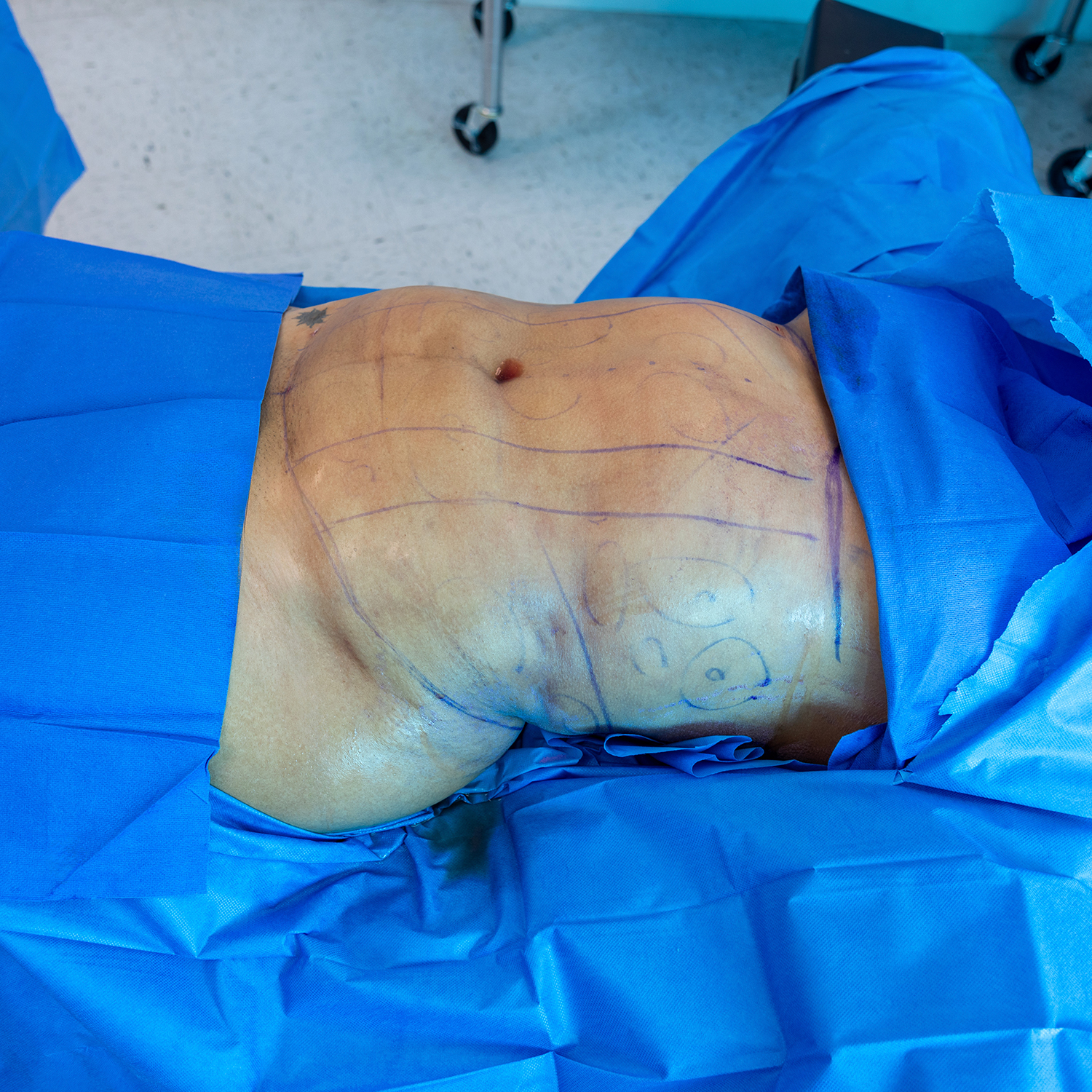 3-morales-lipo-before