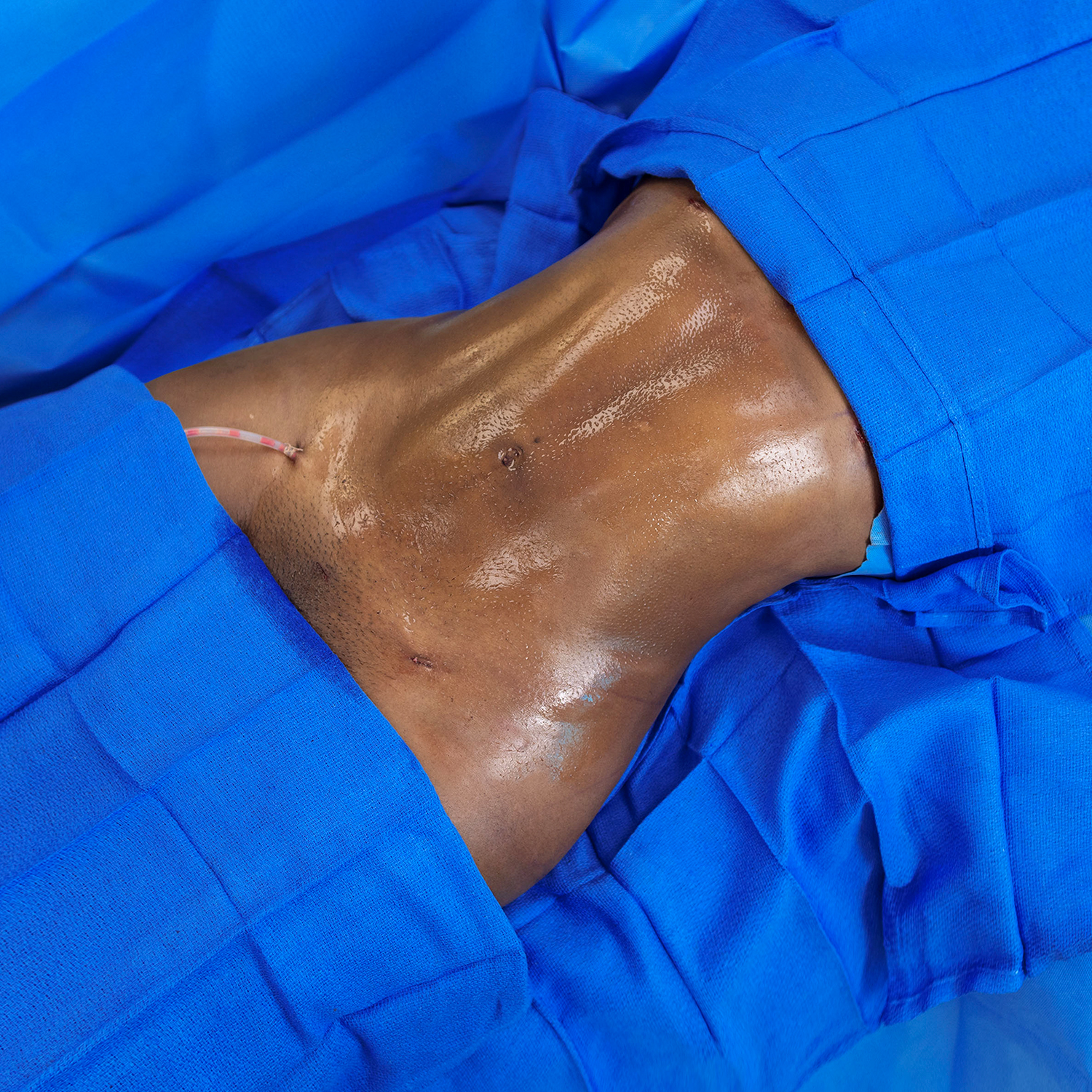 4-morales-lipo-after